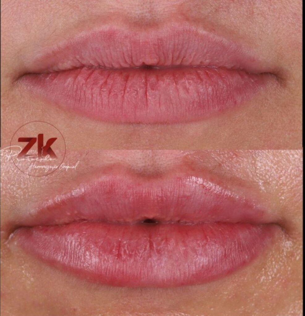 Antes e depois — escultura labial pelo Protocolo ZK